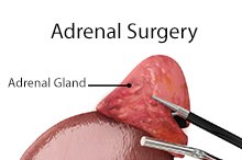Adrenal Surgery