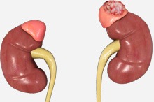 Adrenal Tumours