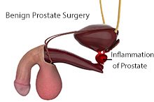 Benign Prostate Surgery