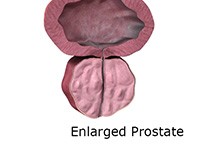 Benign Prostatic Enlargement