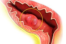 Bladder cancer