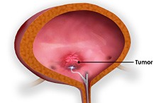 Bladder Tumour Biopsy and Resection