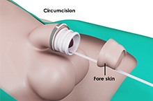 Circumcision