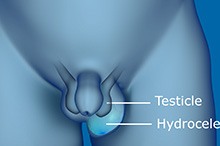 Hydrocele/Spermatocele