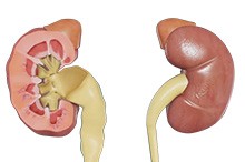 Hydronephrosis