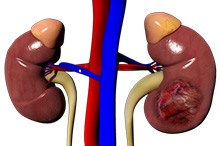 Kidney Cancer