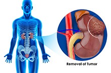 Nephrectomy