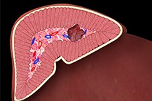 Pheochromocytoma