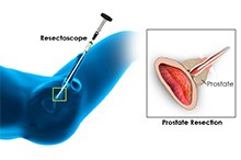 Prostate Resection