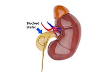 Pyeloplasty