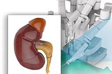 Robotic Dismembered Pyeloplasty