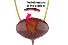 Robotic Partial Cystectomy