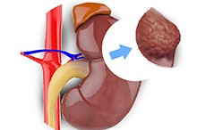 Robotic Partial Nephrectomy