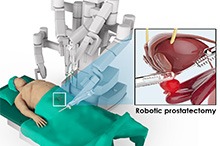 Robotic Prostatectomy