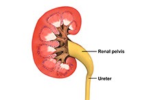 Transitional Cell Cancer